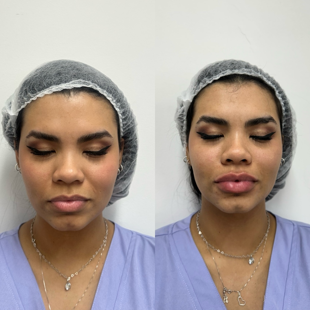Prévia de um resultado real de preenchimento labial